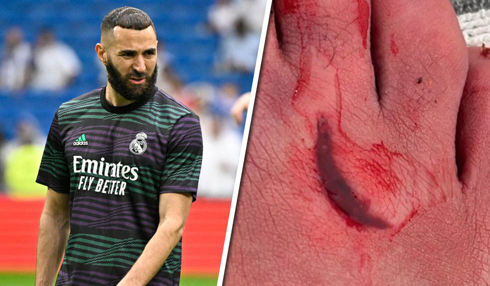 benzema fuß